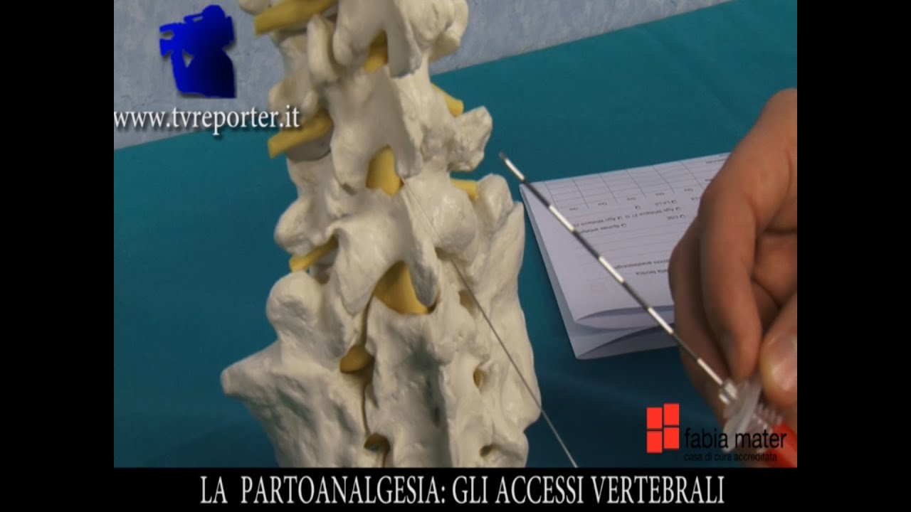 LA PARTOANALGESIA: GLI ACCESSI VERTEBRALI