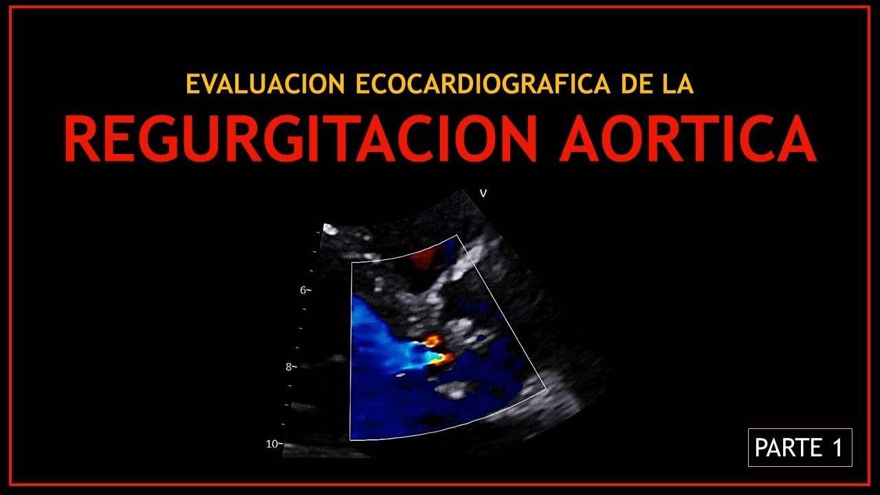 Evaluacion Ecocardiografica de la: REGURGITACION AORTICA (Parte 1)
