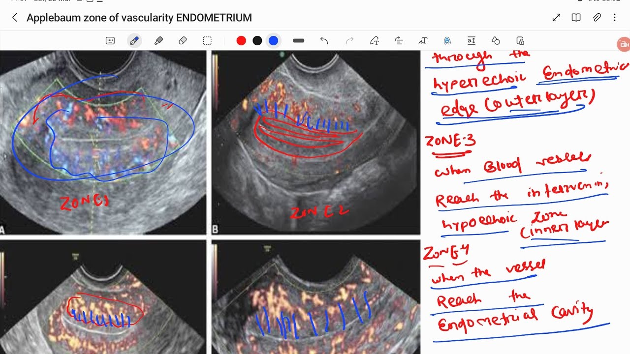 USGDoppler evaluation for endometrial receptivity Applebaum cri(zone of vascularity of endometrium)