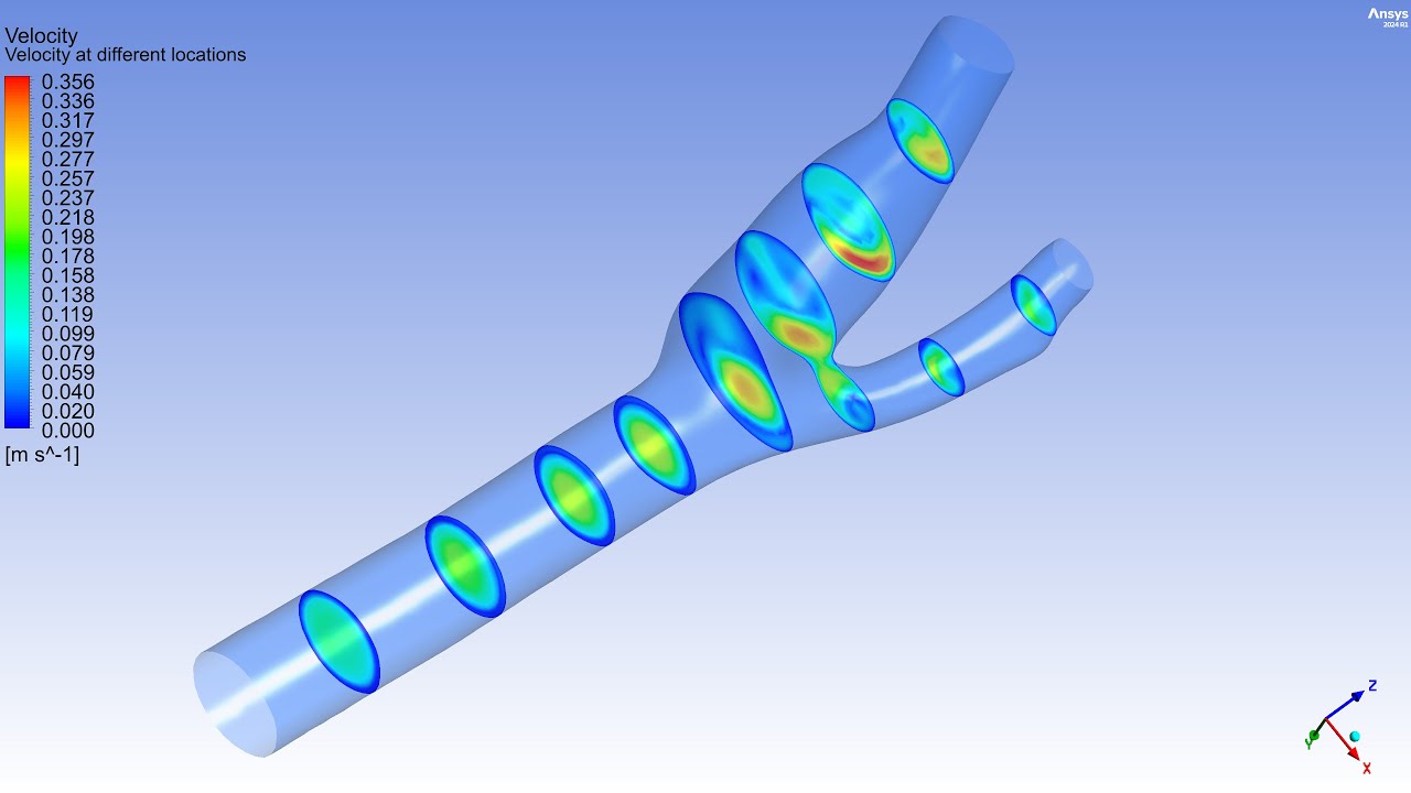 Carotid Bifurcation Artery (Unsteady) | ANSYS Fluent
