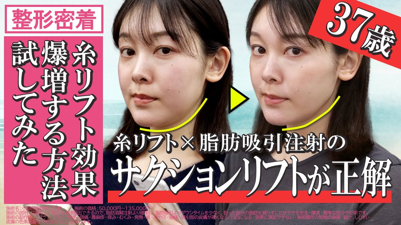 【30代からの失敗したくない糸リフト整形】四角いタルミ顔を卵型にするサクションリフトに密着【アラフォー脂肪吸引注射】湘南美容クリニック