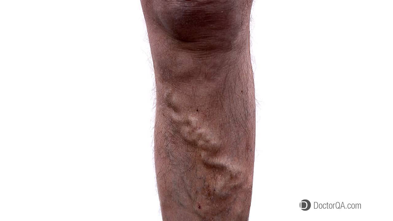 What would I like people with ropy varicose veins to know? - Dr. Joel Erickson