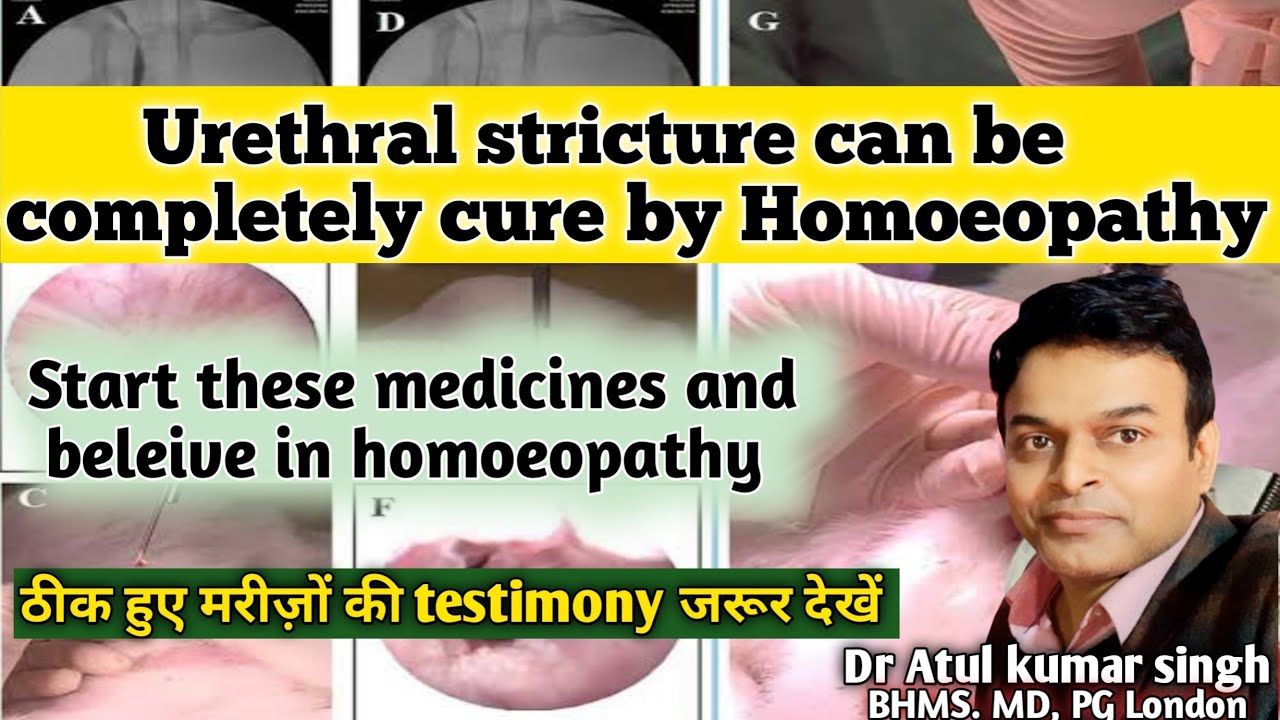 Urethral stricture treatment | Urethral stricture causes symproms & treatment | मूत्र नली में रुकावट
