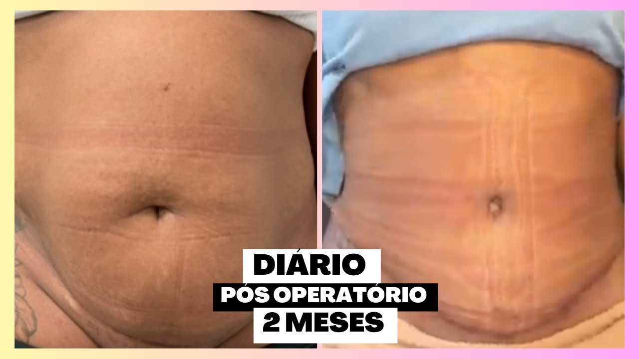 2 MESES PÓS OPERATÓRIO | Talita Oliveira