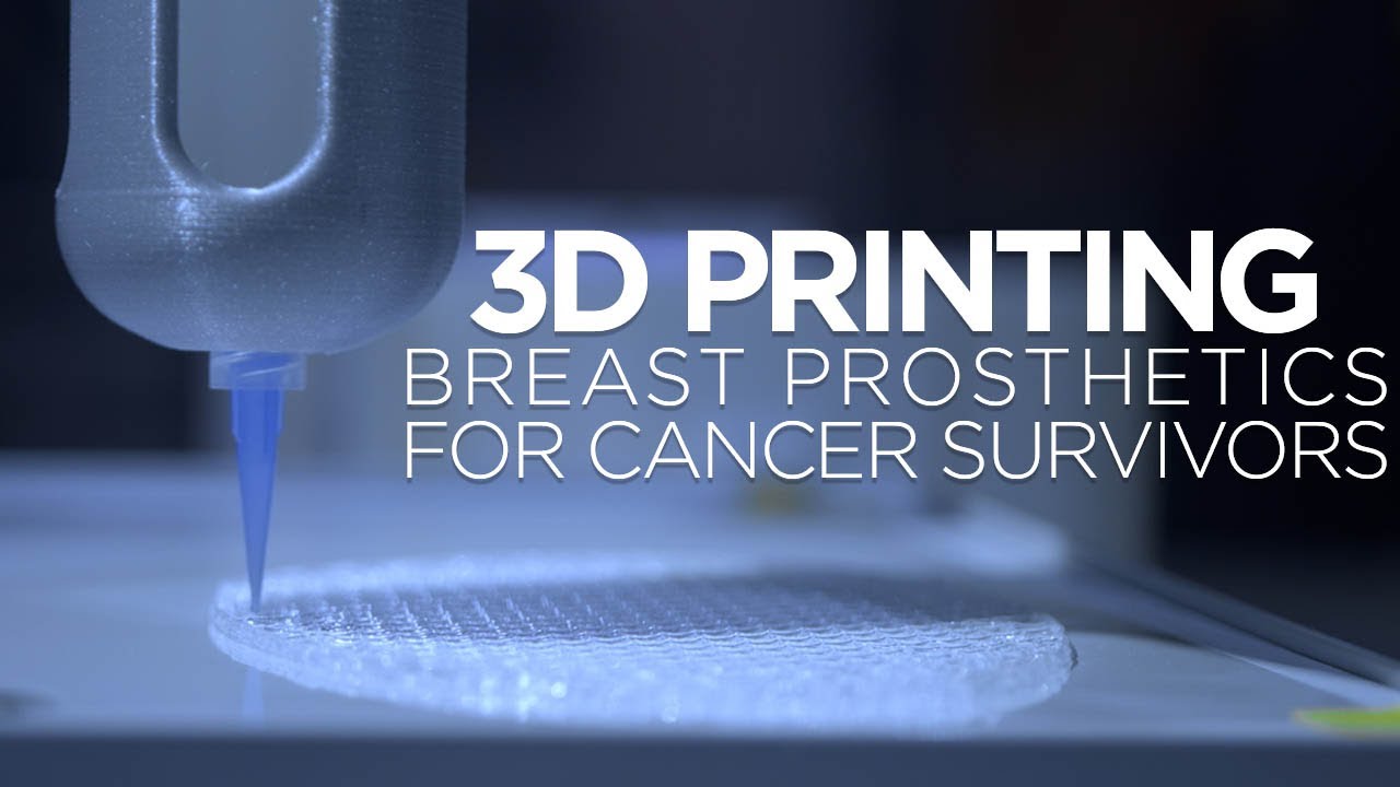 3D Printing Technology Benefits Breast Cancer Survivors