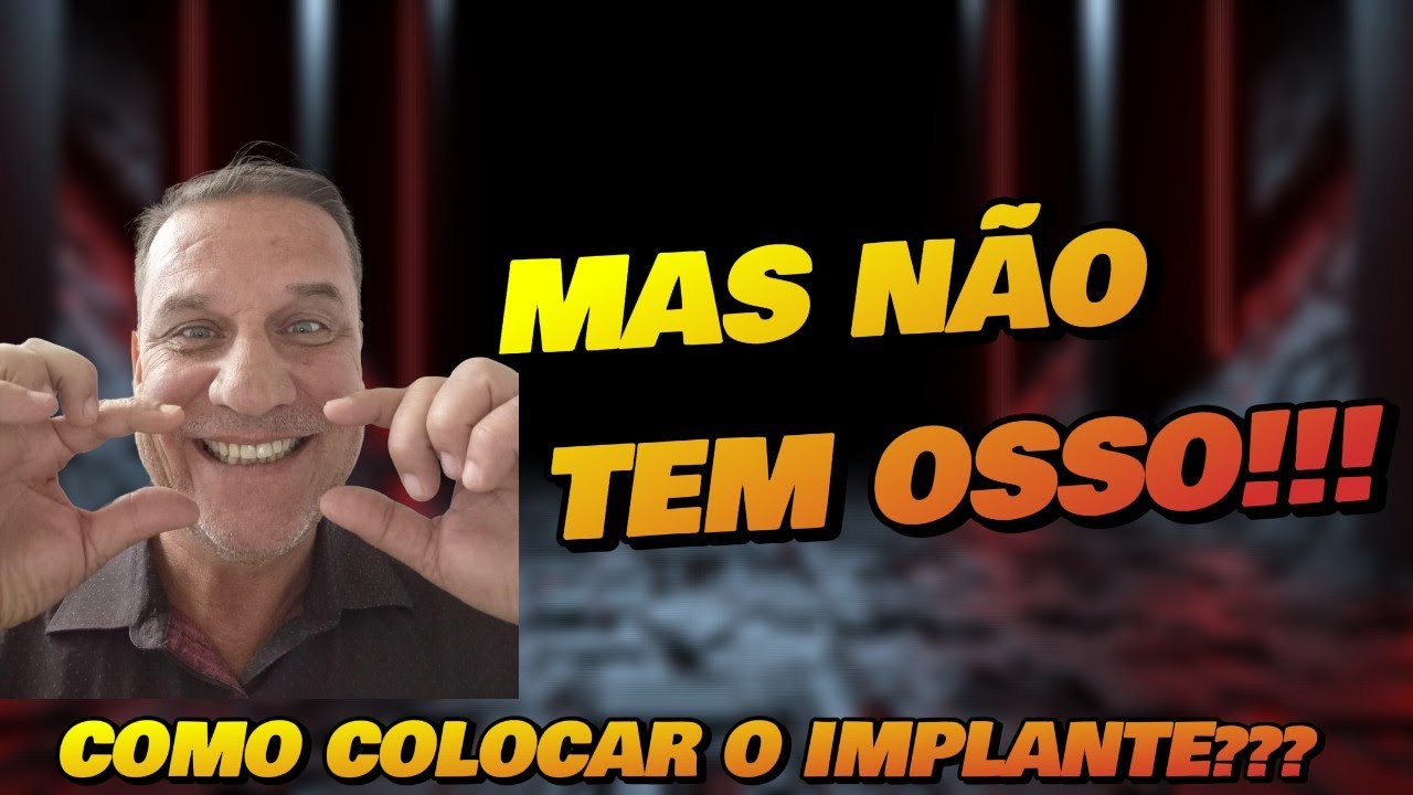 ALL ON FOUR: COMO FAZER IMPLANTES MESMO SEM TER OSSO SUFICIENTE? 🤔🦷