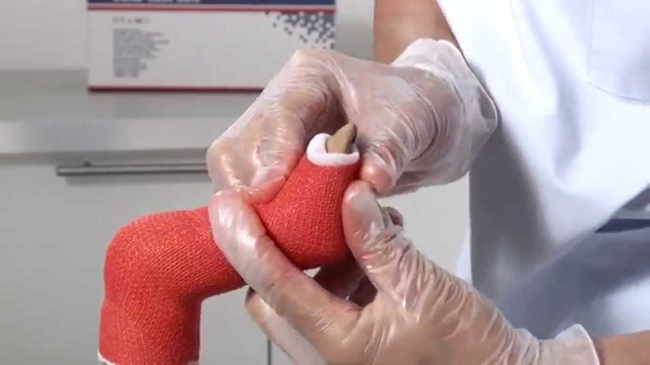 Delta-Cast Soft Club Foot Cast Application