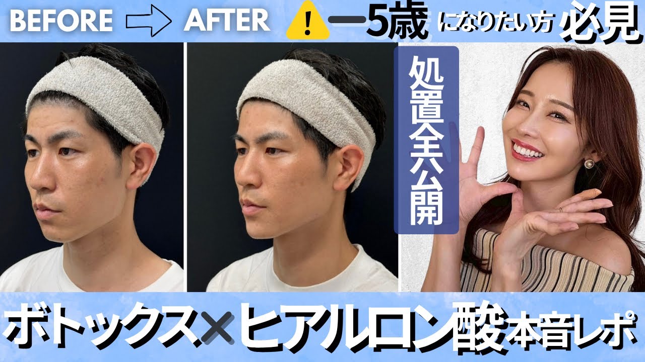 【ボトックス×ヒアルロン酸  本音レポ】自然に簡単マイナス5歳。即効性抜群！ オーダーメイドによる注入処置全顔ケア。カウンセリング、施術、効果について医師と徹底解説