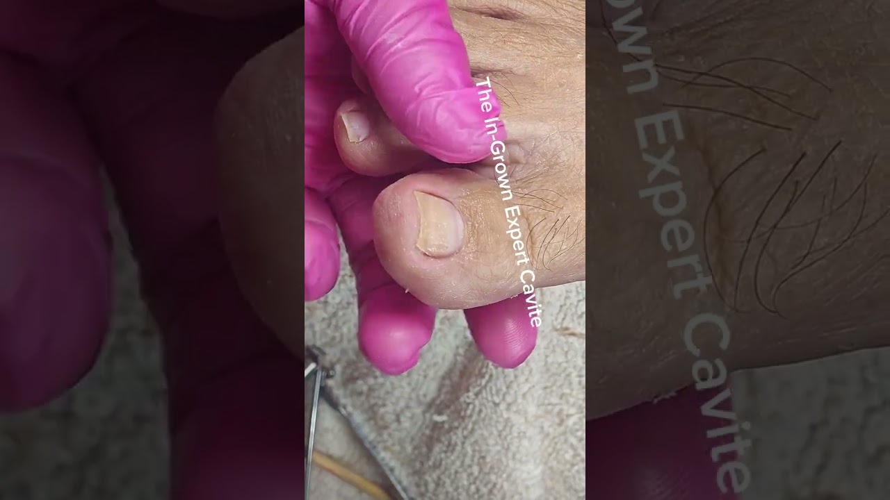 Full video pedicure and Dryskin removal 