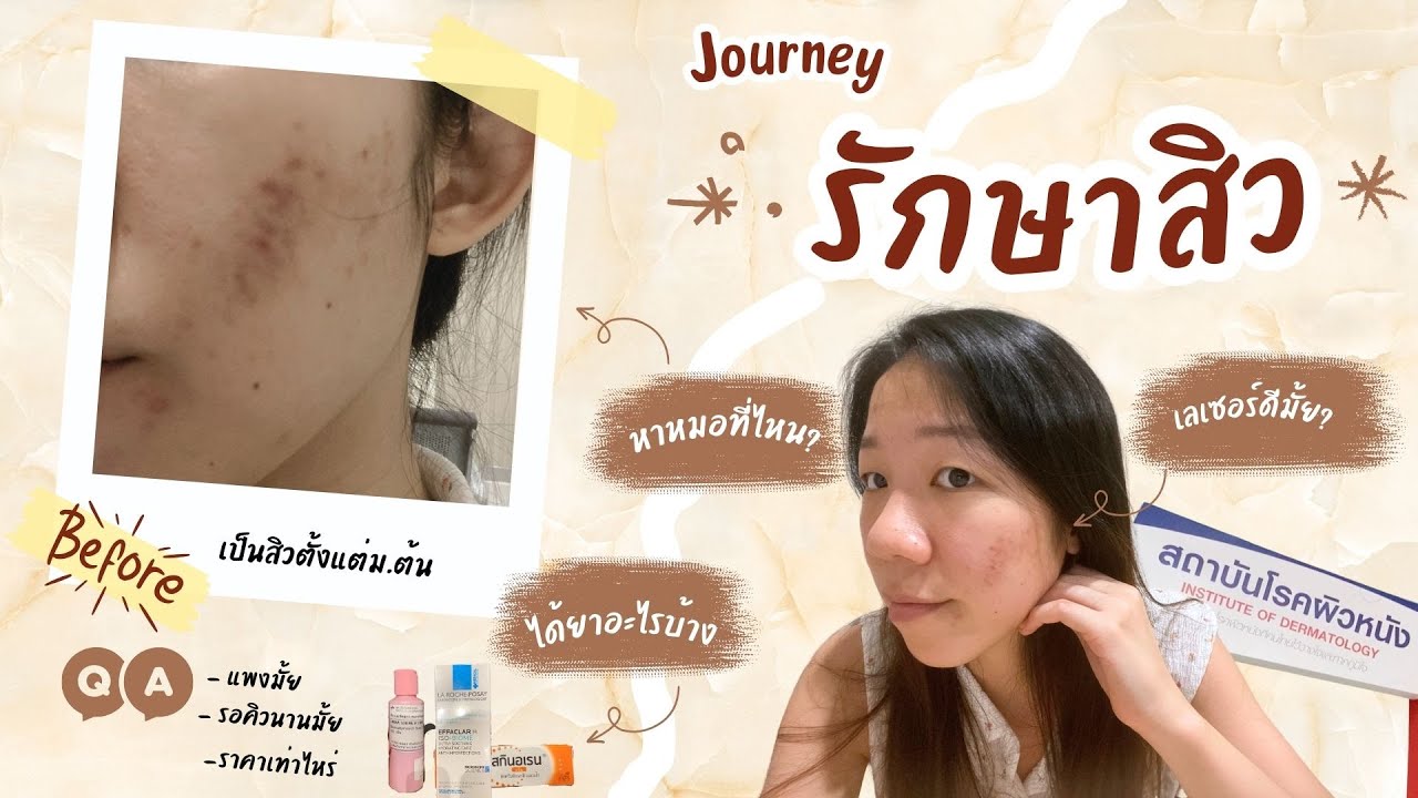 Journey รักษาสิว Ep. 1 ที่สถาบันโรคผิวหนัง / รีวิวยาและค่าใช้จ่ายทั้งหมด | MuaiJK