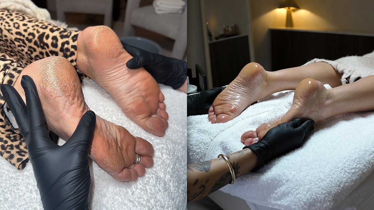 Heavy Dry Hard Skin Removal & Hydrating Massage Transformation