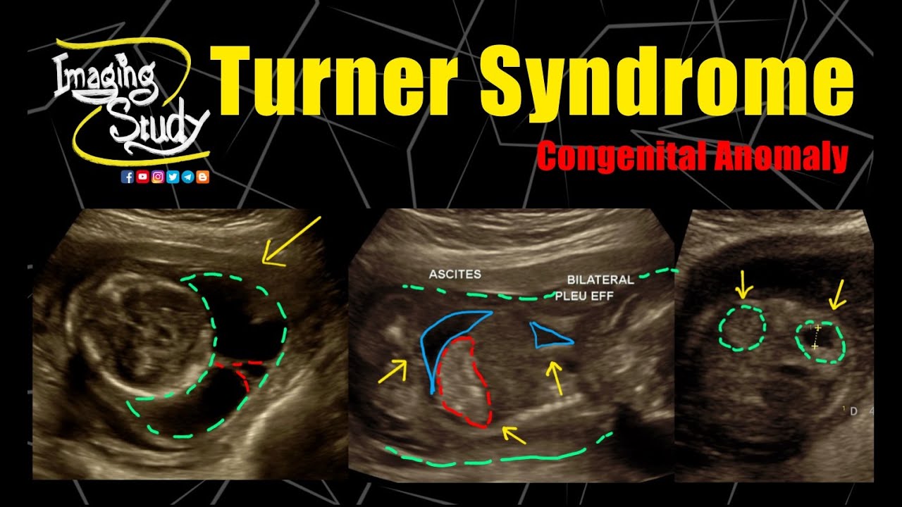 Turner Syndrome | 45,X | Monosomy X || Ultrasound || Anomaly || Case 276