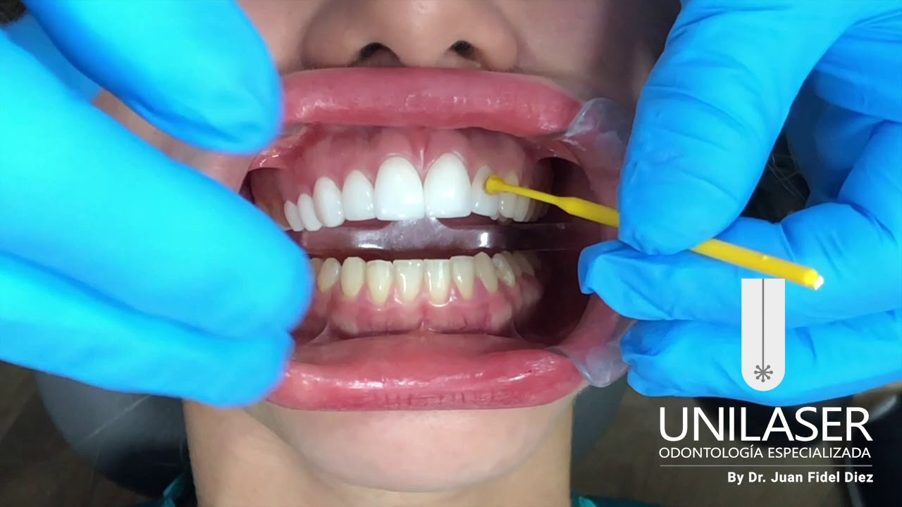 Unilaser | Diseño de Sonrisa con 20 Lentes Cerámicos