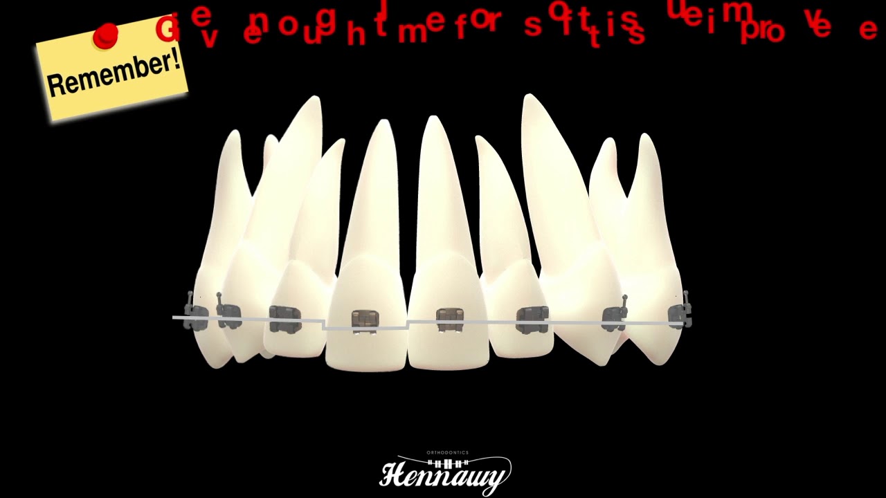 orthodontics finishing bends part1 z- bend step bend