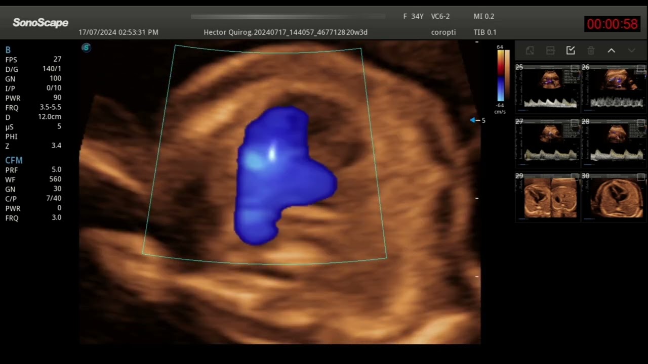 Evaluación del corazón fetal en un embarazo de 20 semanas.