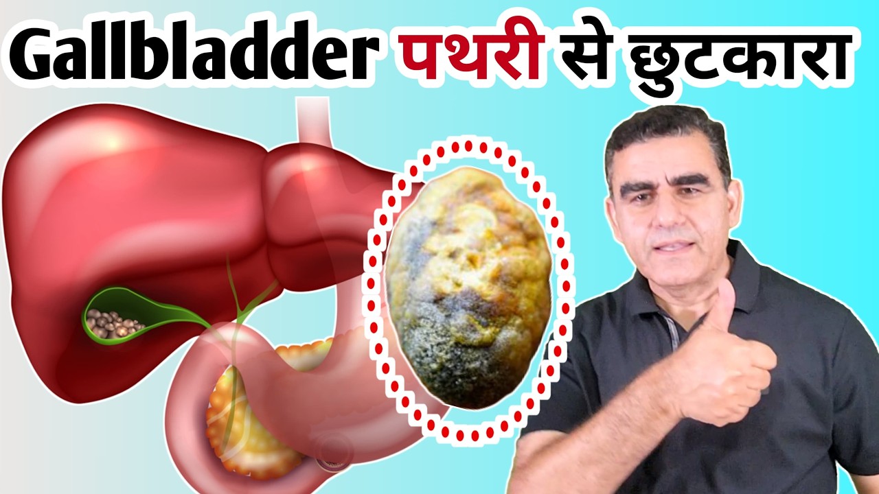 Gall Bladder Stone Treatment Without Surgery? | Gallbladder Stone Symptoms | Gallstone Symptoms
