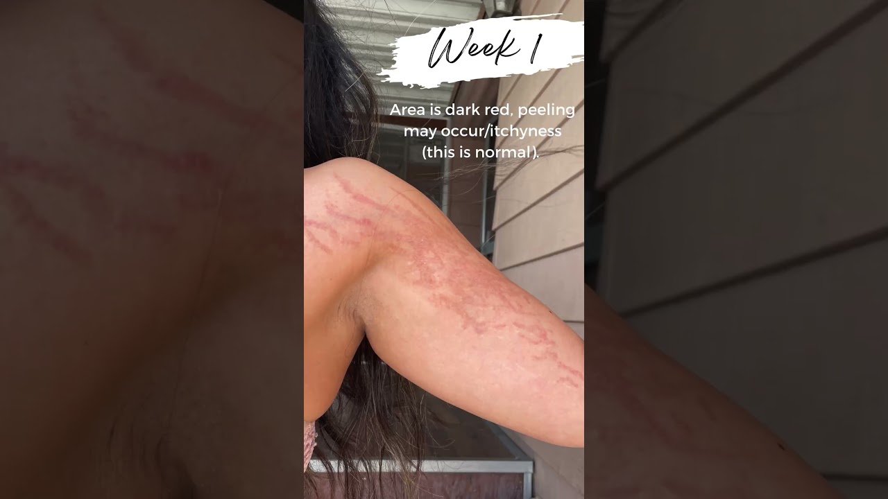 Healing Process For Inkless Stretch Mark Treatment (WATCH TILL END) #youtubeshortsvideo #shortsfeed