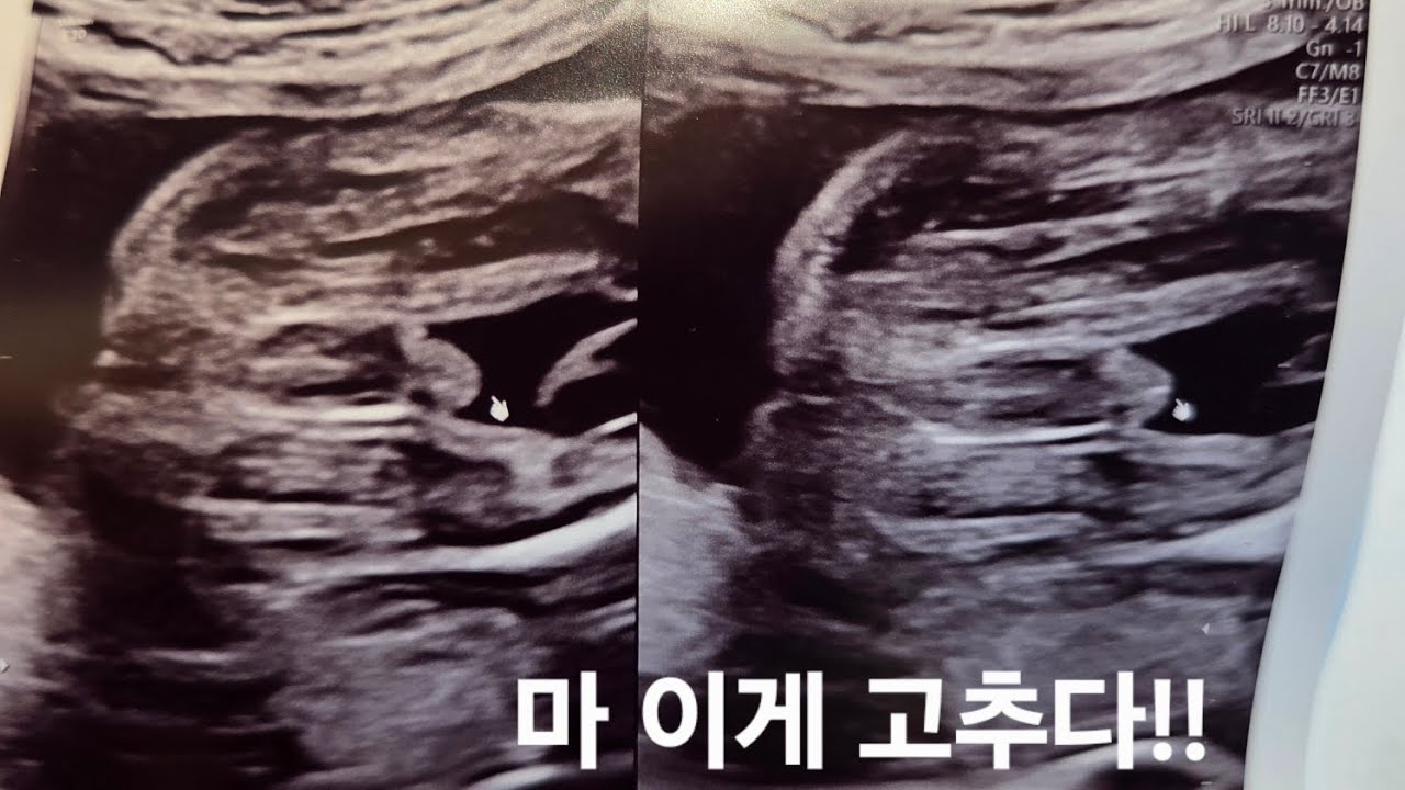 열무 25주차 초음파
