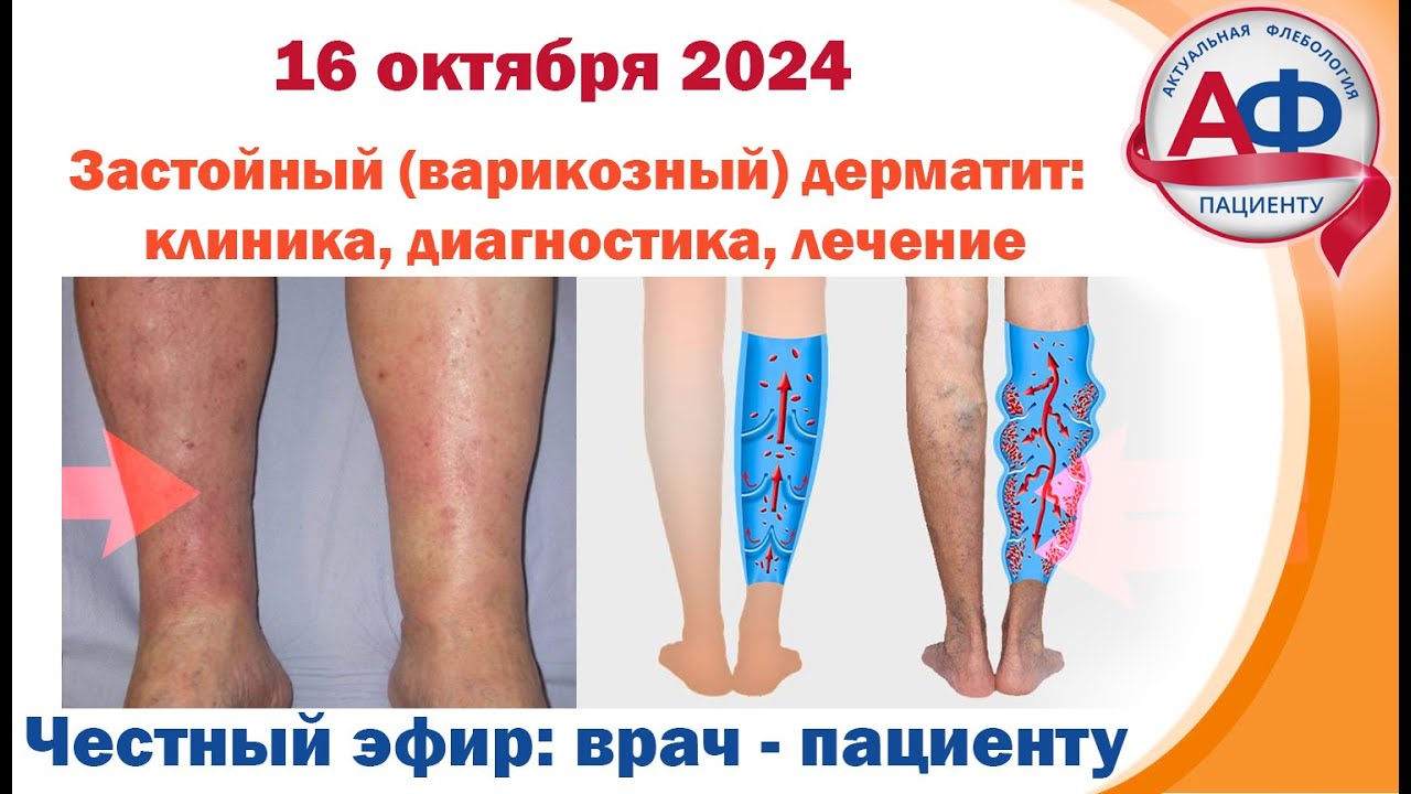 Застойный варикозный дерматит  клиника, диагностика, лечение