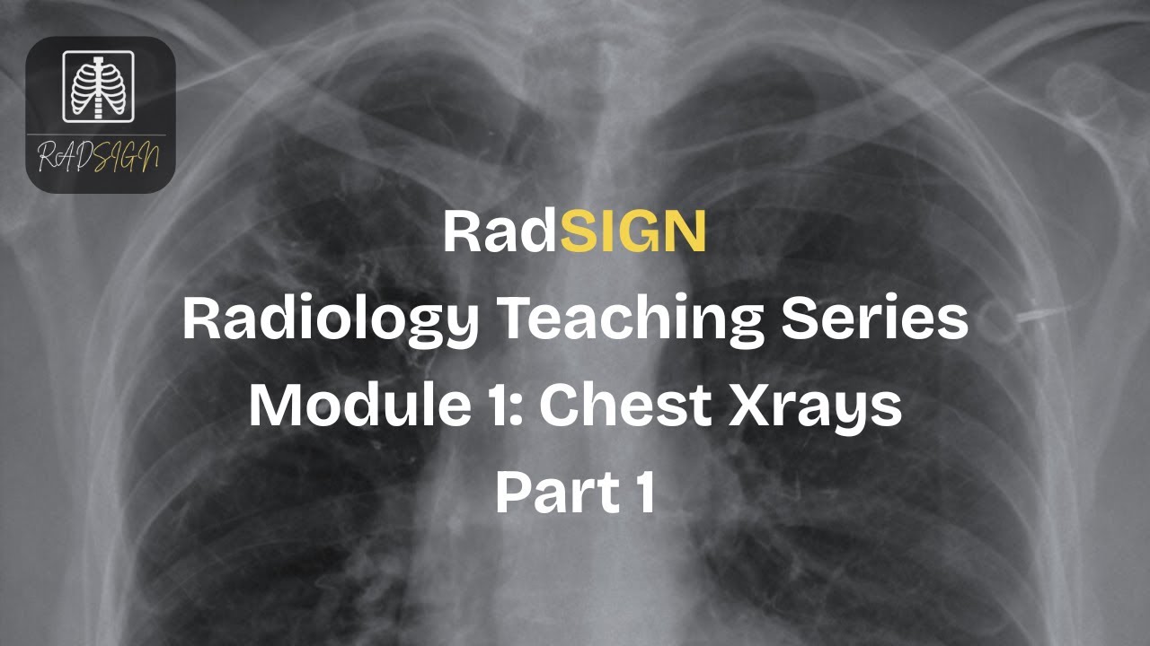 Chest X-Ray Interpretation Made Simple | Opacity, Consolidation, Atelectasis & More | RadSIGN