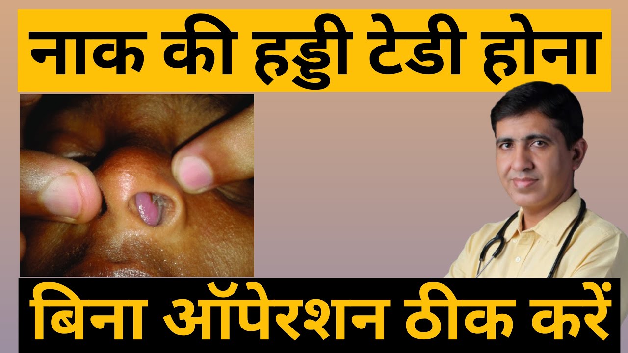 DNS | नाक की हड्डी टेडी होना | नाक की हड्डी टेडी हो तो क्या करे | Deviated Septum Symptoms