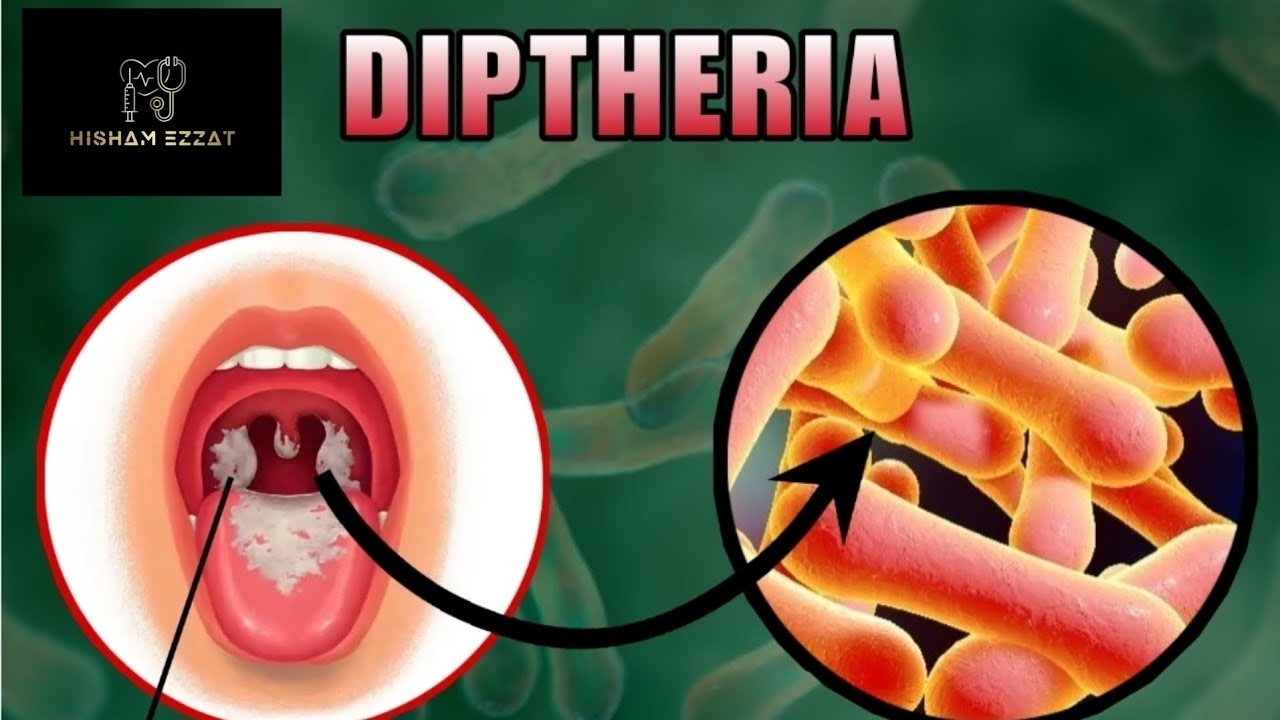 Diphtheria | الخناق