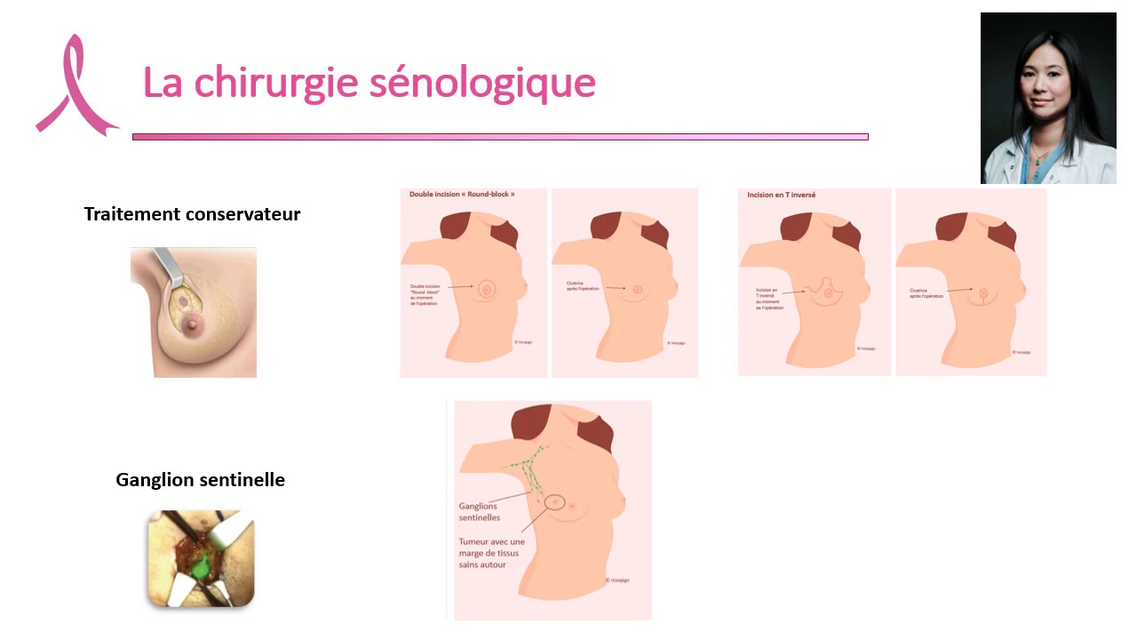Les différentes étapes de la prise en charge du cancer du sein