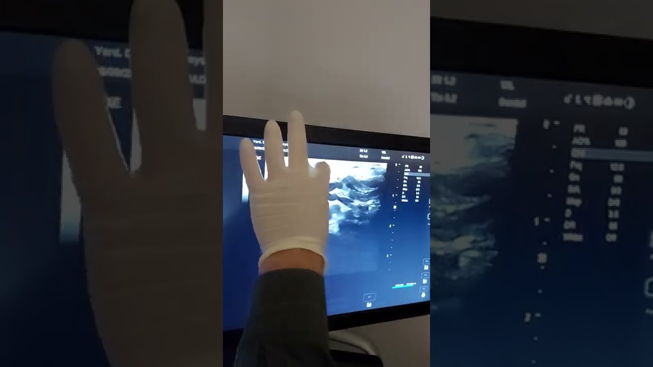 Our patient from United Kingdom with failed Varicocele Embolisation