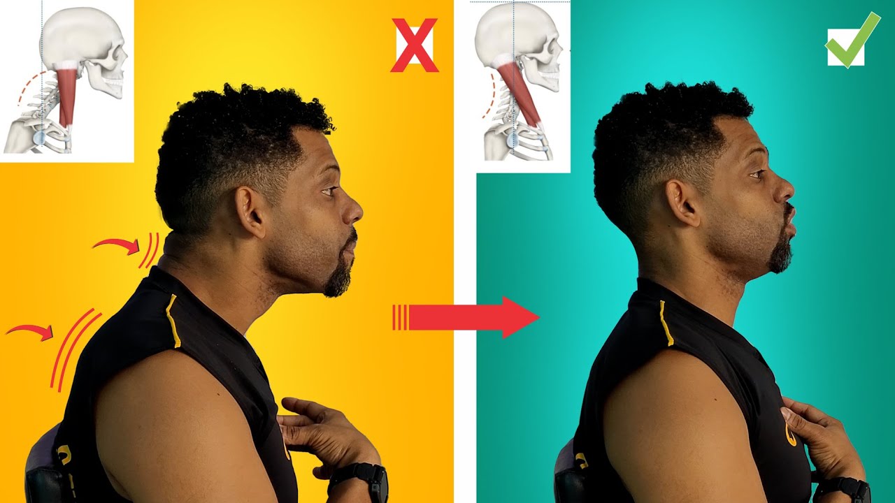 ADEUS PESCOÇO P/ FRENTE - Teoria + exercícios de como CORRIGIR A CORCUNDA - Adeus corcunda