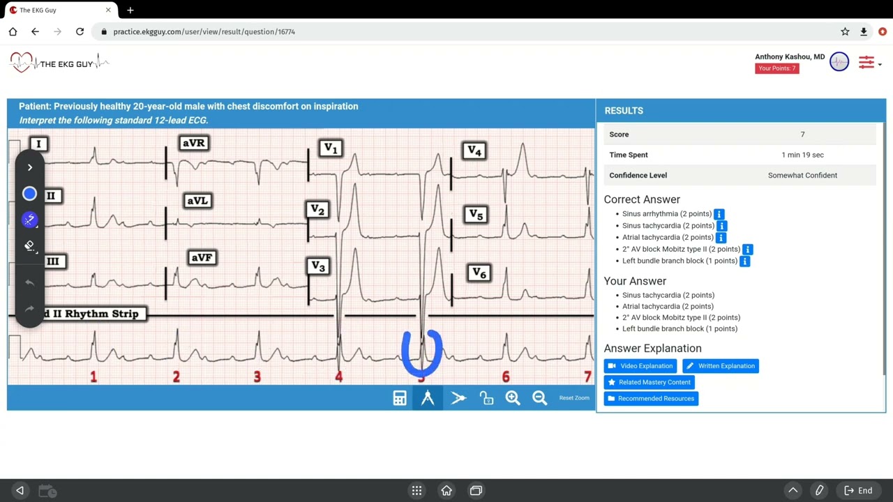 ECG Interpretation Case Walk-Thru | The EKG Guy