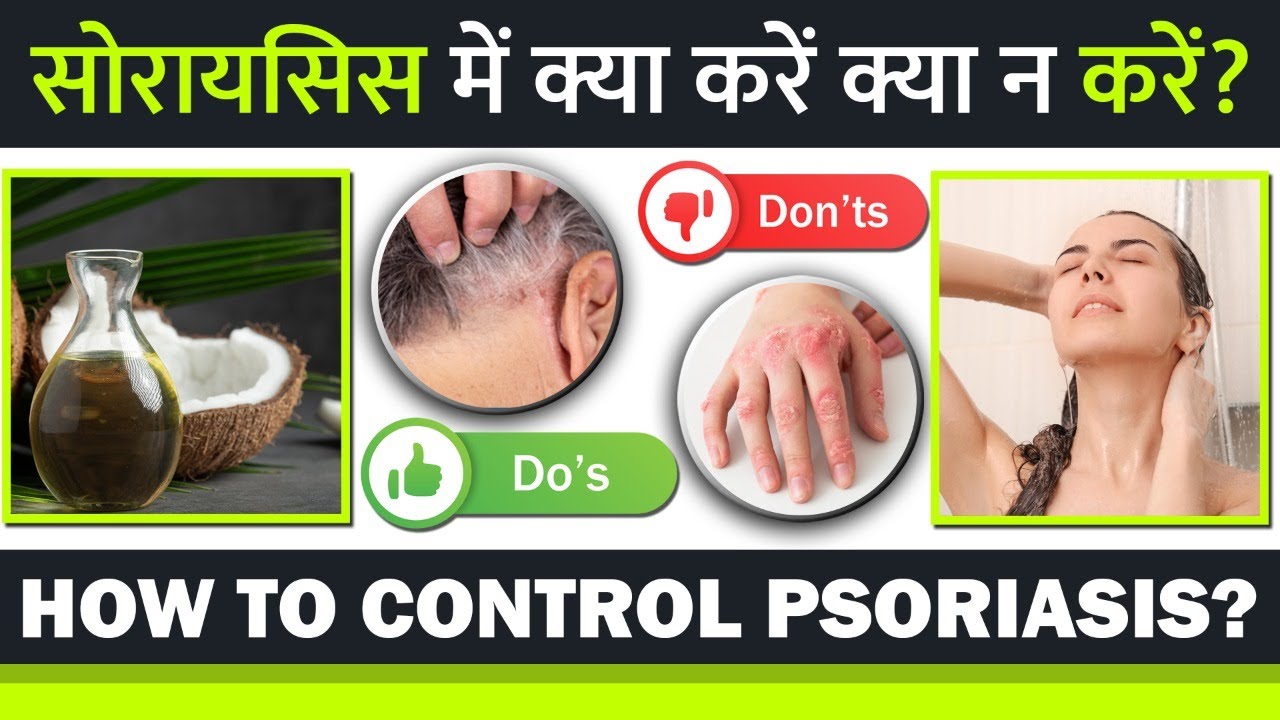 (Psoriasis Tips) सोरायसिस में क्या करे क्या न करें? 3 Do's & Don't for Psoriasis Patients in Winter