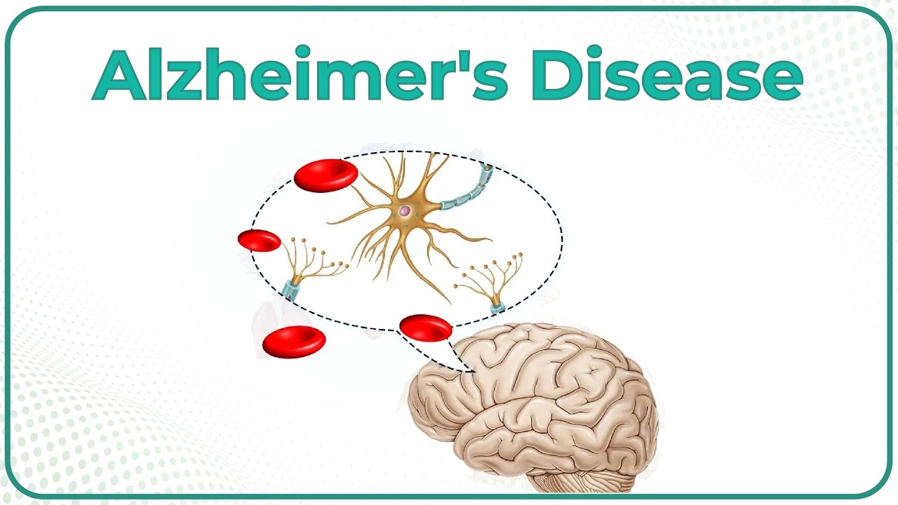 Alzheimer's disease : Etiology, Pathophysiology, Signs and symptoms, Diagnosis and Treatment