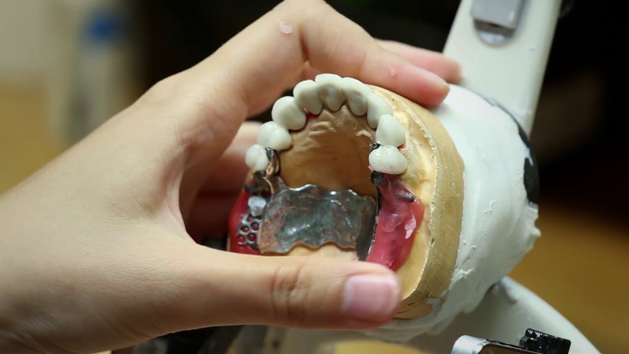 Prothèse clipsée sur dents [Réalisation] - Endurance Implant