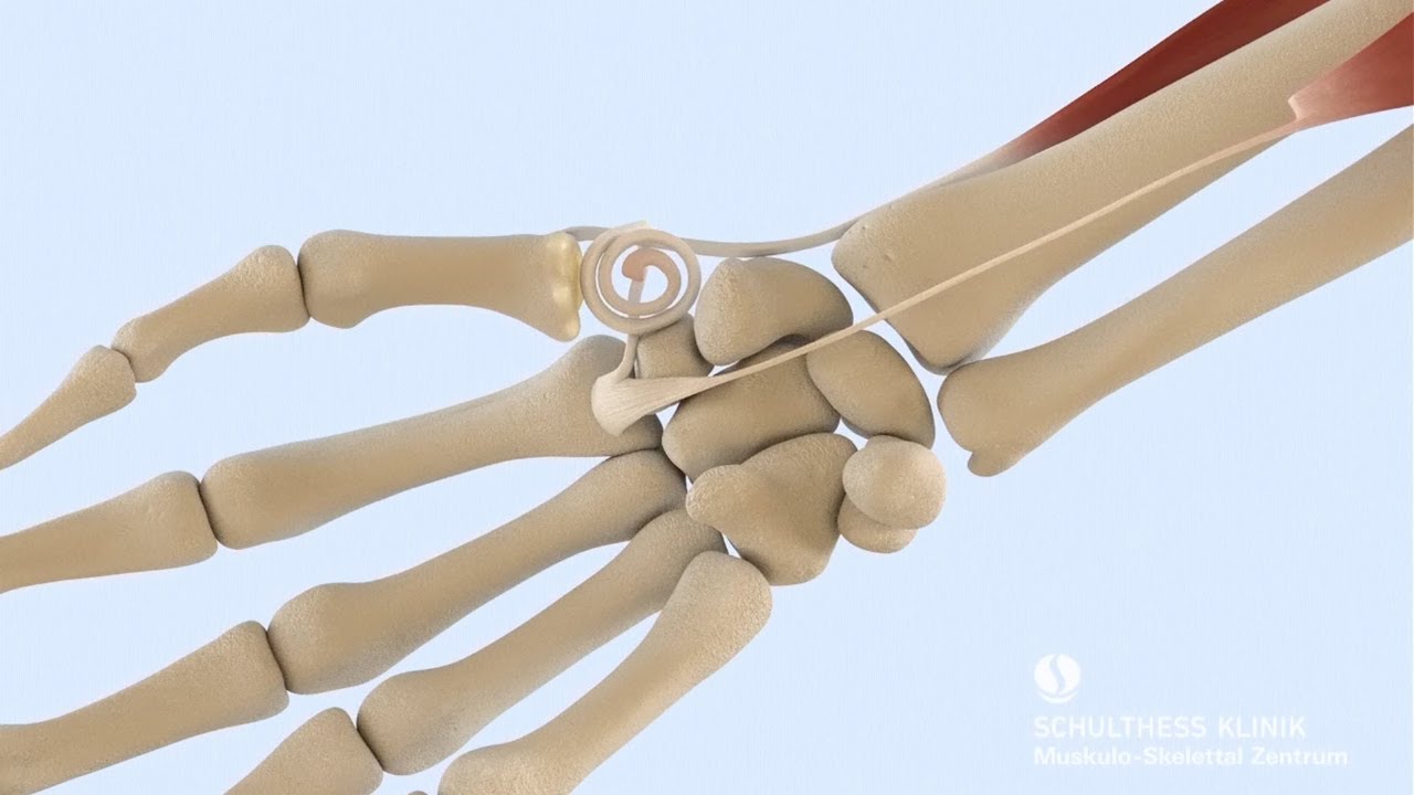 &laquo;Behandlung Daumensattelgelenk-Arthrose&raquo; - Schulthess Klinik