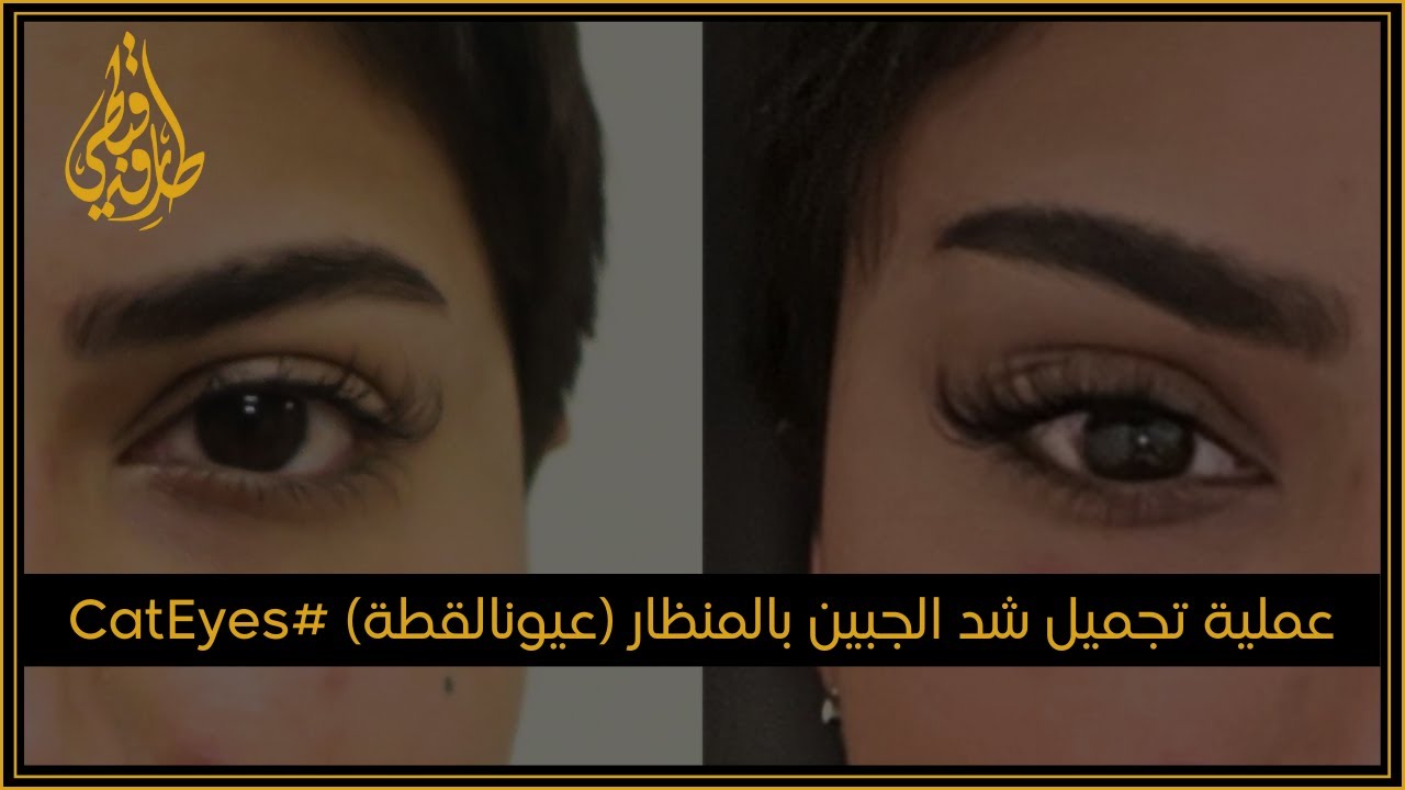 مركز الدكتور طارق قبطي | عملية تجميل شد الجبين بالمنظار #عيون_القطة #CatEyes