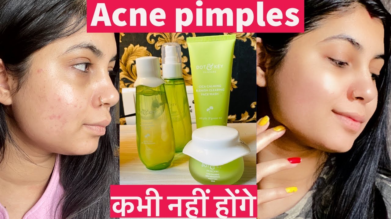 7 days Acne treatment challenge ! #BreakupwithAcne || Skin Care for Acne prone skin ||