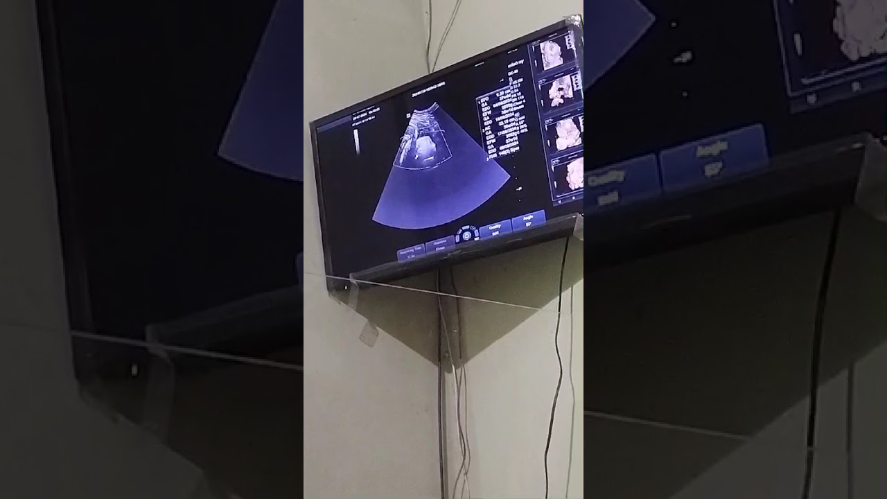 USG Hamil Anak Ke Dua (Part 4)