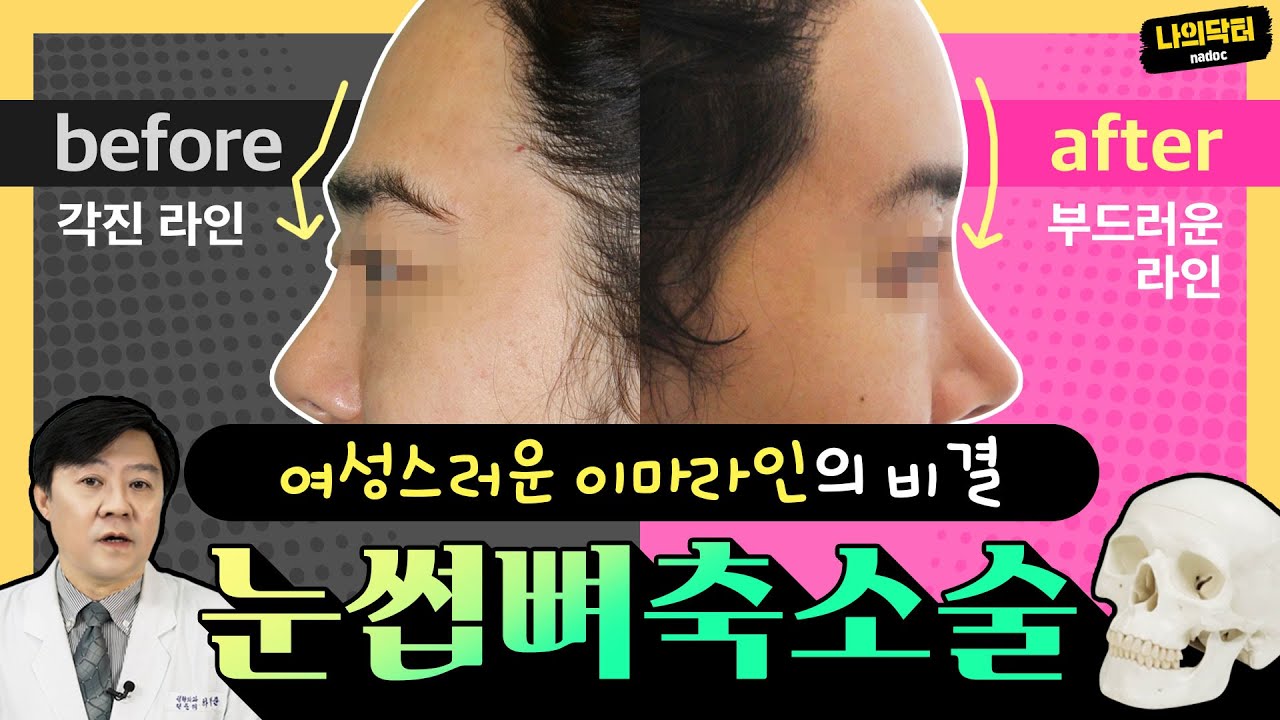 눈썹뼈축소술 2탄! 울퉁불퉁 이마라인, 튀어나온 눈썹뼈가 문제였다! 지방이식, 보형물 삽입으로 안 되는 문제가 있는 이마를 해결하는 눈썹뼈축소술! - 닥터 하범준