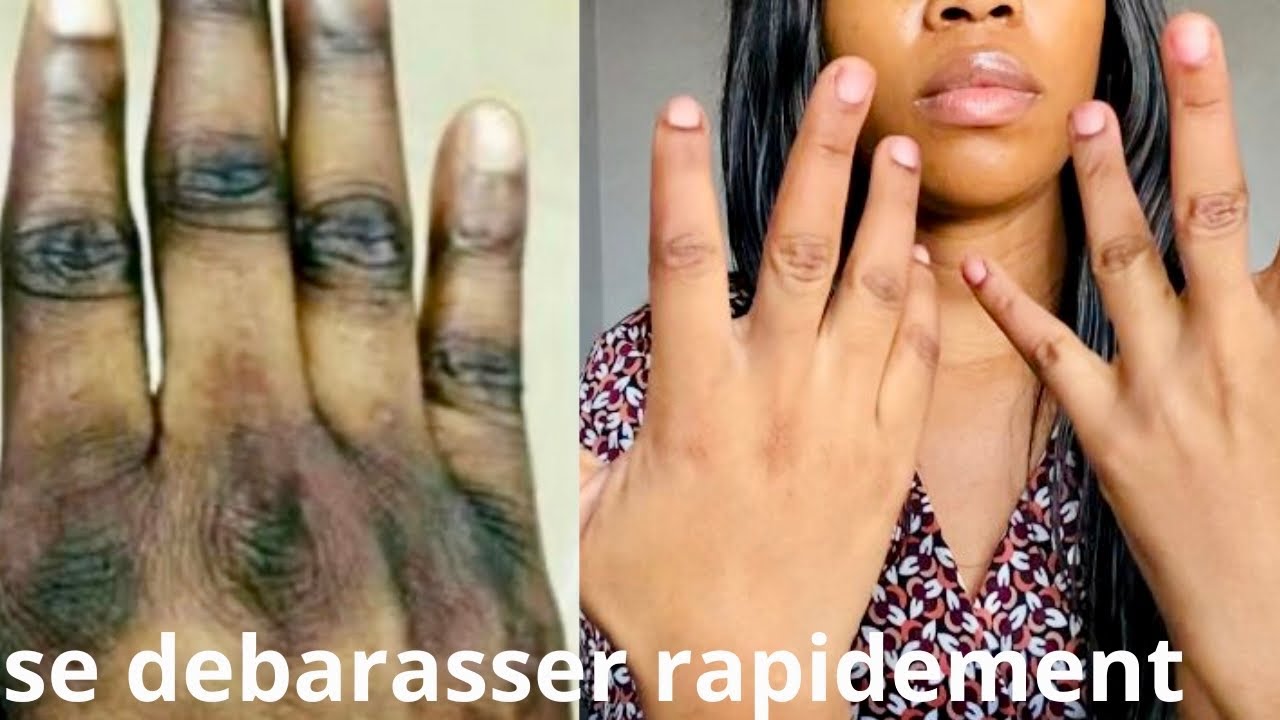 COMMENT SE DÉBARRASSER DES QUINTOS RAPIDEMENT 💯naturel,très efficace 🔥