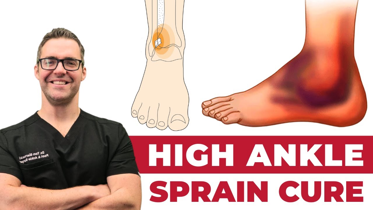 High Ankle Sprain Treatment [Causes, Exercises & Recovery Time]