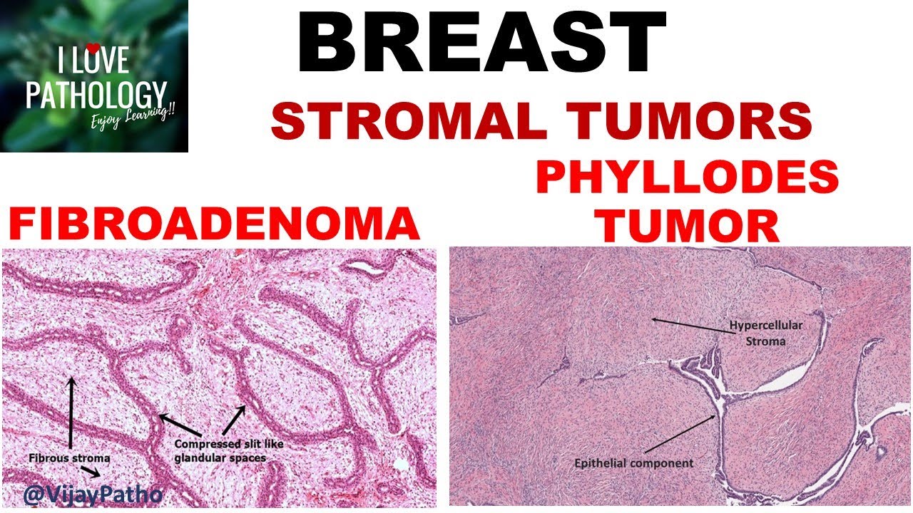 Diseases of Breast: Part 3: Fibroadenoma & Phyllodes tumor