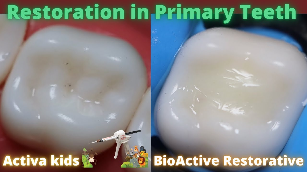Restoration in Primary Teeth ⚪️ Activa kids BioActive Restorative 🟢 Simulated Demonstration