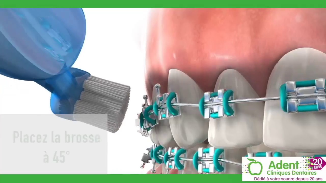 Hygiène dentaire en orthodontie