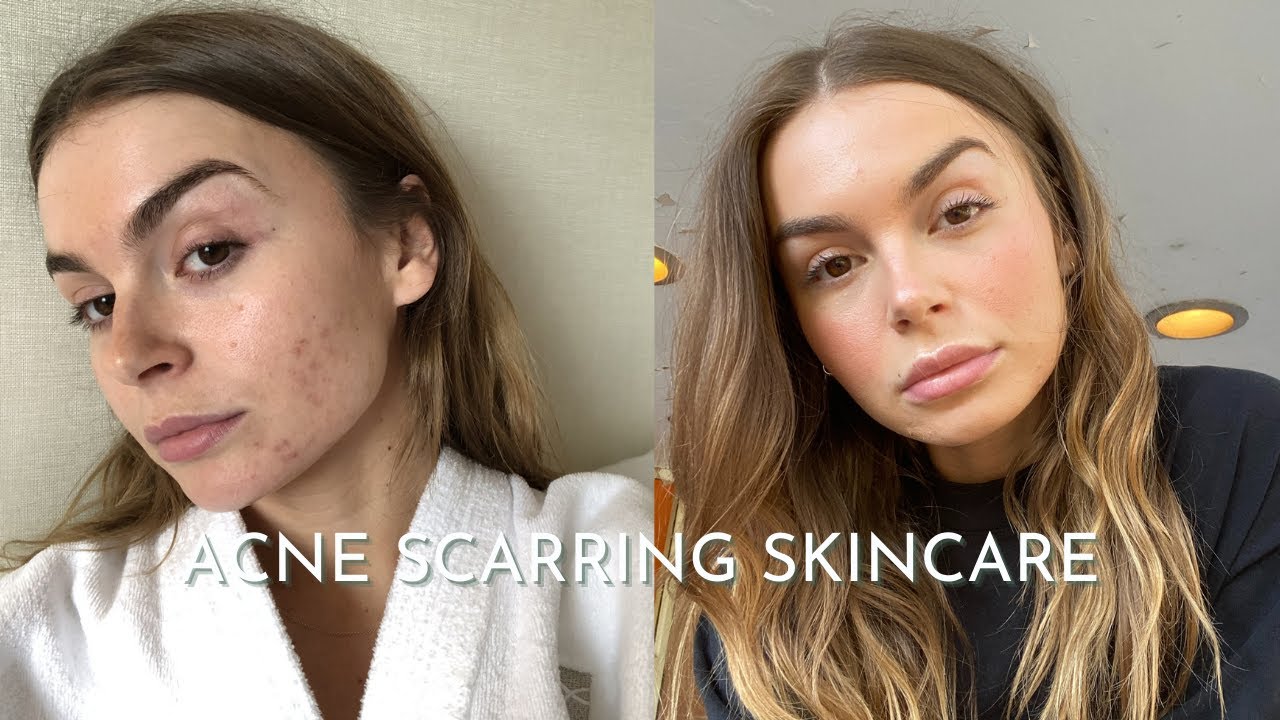 SKINCARE ROUTINE | simple skincare for acne & scarring