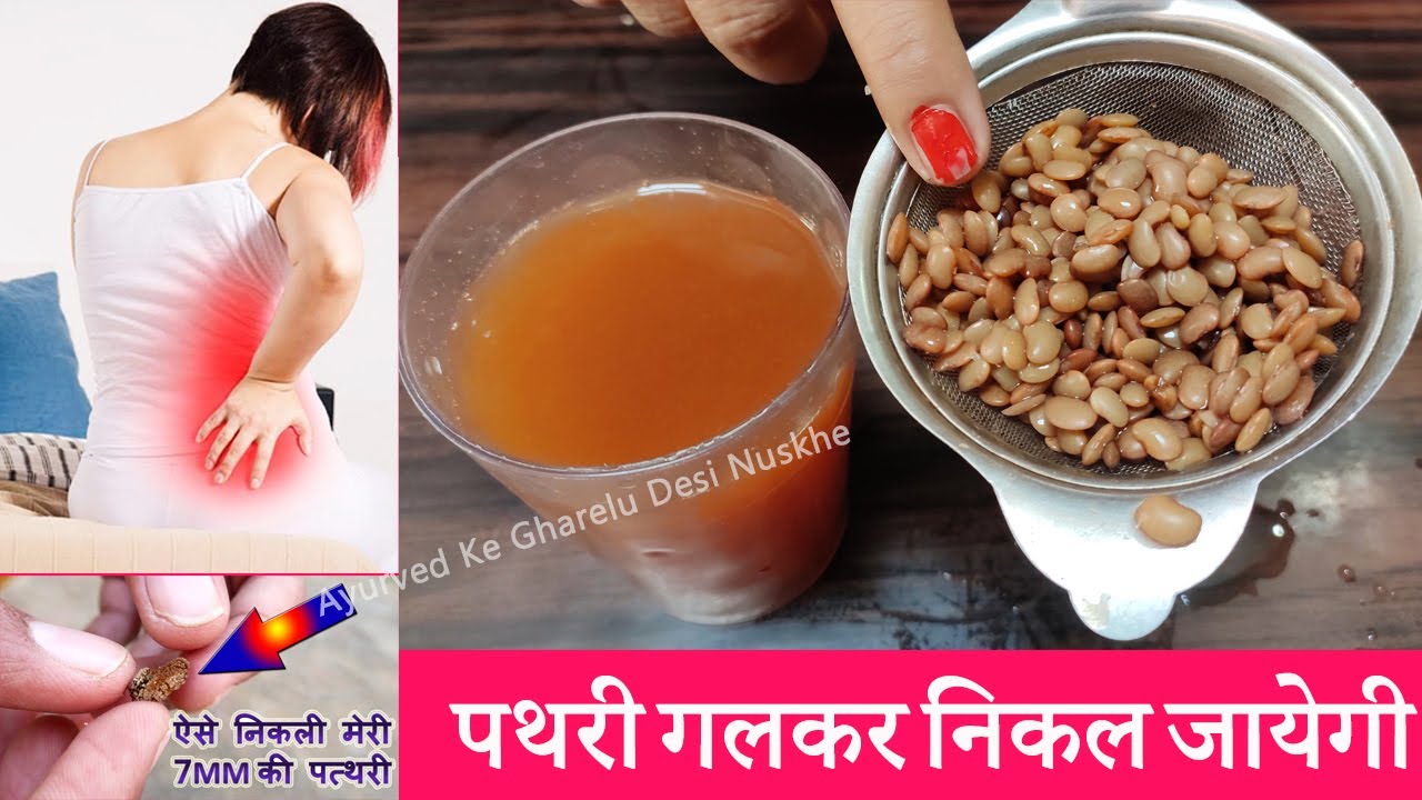 ये दवा पथरी को 100% गलाकर निकाल देगी | Kulthi Dal ke Fayde, Pathri Ka ilaaj, Stone Treatment
