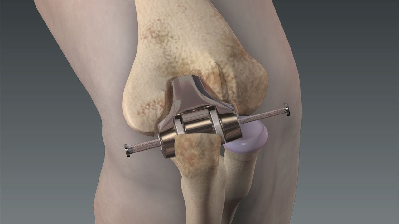 Elbow Replacement - Mayo Clinic