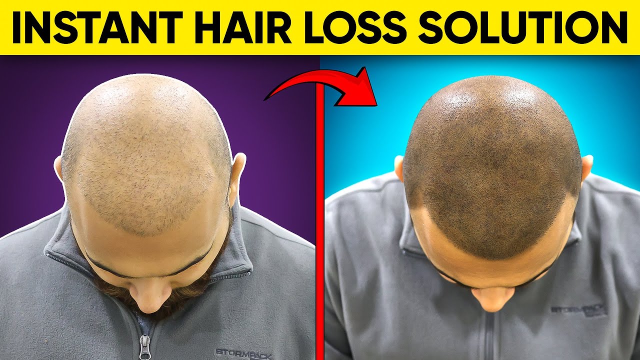 Instant HAIR LOSS Treatment - Scalp Micropigmentation in India | SMP Hair