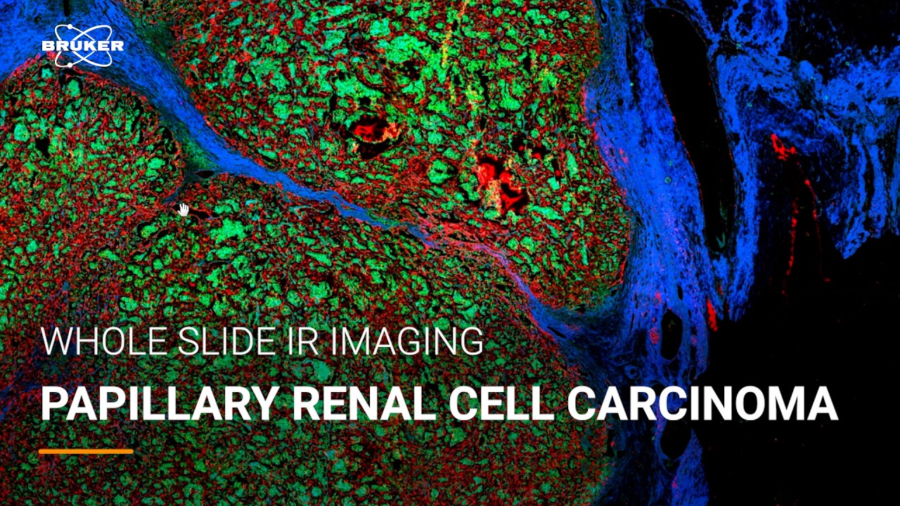 Papillary Renal Cell Carcinoma classified by IR Spectral Pathology | Cancer Detection