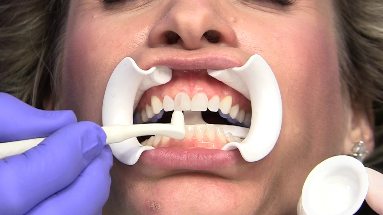 Lumineers® Placement Step-by-Step - DenMat Dental Education