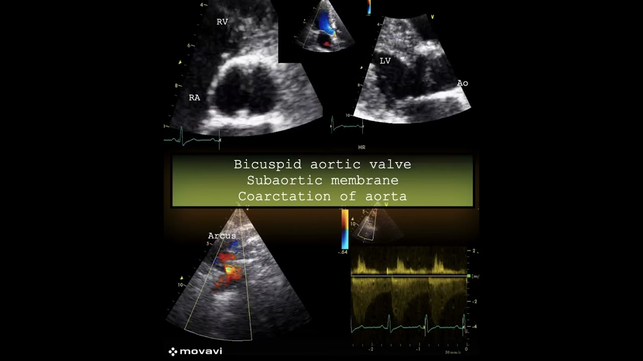 Bicuspid aortic valve/ subaortic membrane /coarctation of aorta